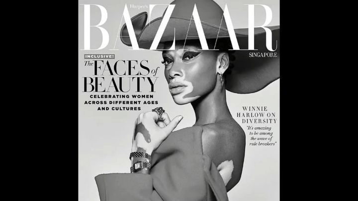 وینی هارلو - مدلی که با بیماری پوستی درحرفه مدلینگ درخشید !